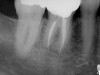 Successful Deep Root Canal (Before)