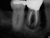 Successful Deep Root Canal (After)