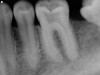 Molar Root Canal (Before)
