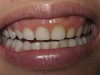 Esthetic Gingivectomy Crown Lengthening (Before)