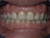 Esthetic Gingivectomy Crown Lengthening (After)