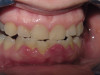 Gingivectomy Gum Disease Removal (Before)