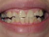 Gingivectomy Gum Disease Removal (After)