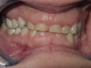 Gingivectomy Crown Lengthening (Before)