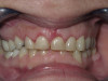 Gingivectomy Crown Lengthening (After)