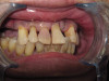 Immediate Dentures (Before)
