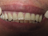 Immediate Dentures (After)