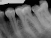 Second Molar Root Canal (Before)