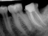 Second Molar Root Canal (After)