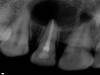 Severe Abscess (Before)