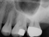 Molar Root Canal Upper (Before)