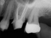 Molar Root Canal Upper (After)