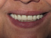 Implant Supported Dentures (With Teeth)