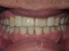 Implant with orthodontic treatment (After)