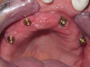 Denture with Multiple Implants Support (Removable)