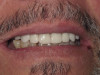 Denture with Multiple Implants Support