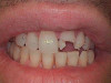 Immediate Implant (Before)