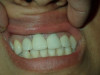 After Immediate Implant Front Tooth