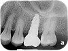 Upper Molar Implant WITH SINUS BUMP