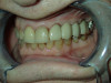 Fixed Partial Denture with Multiple Implants Support