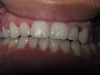 5 Month Treatment (After)