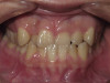 Severe Crowding, 9 Month Treatment (Before)