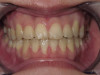 Severe Crowding, 9 Month Treatment (After)