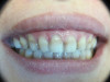 Veneers (Before)