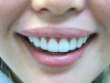 Veneers (After)