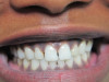 Veneers (Before)