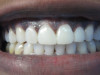 Veneers (After)