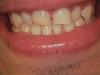 Upper Front 4 Veneers (Before)