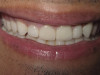 Upper Front 4 Veneers (After)