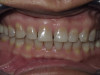 Front Teeth Veneers (Before)