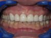 Front Teeth Veneers (After)