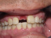 Single Implant, Front Tooth (Before)