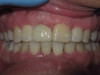 Single Implant, Front Tooth (After)