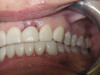 Immediate Implant, Front Tooth (Before)