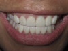 Immediate Implant, Front Tooth (After)