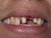 Front Teeth Bridge (Before)