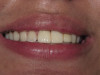 Front Teeth Bridge (After)