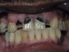 Front Teeth Circonia Crowns (Before)