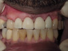 Front Teeth Circonia Crowns (After)