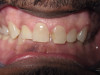 Four Veneers, Upper and Lower (Before)