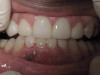 Four Veneers, Upper and Lower (After)