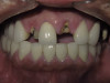 Four Broken Front Teeth (Before)
