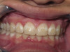 Discolored Front Teeth (Before)