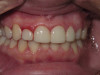 Discolored Front Teeth (After)