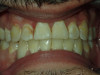 Veneers (Before)