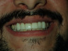 Veneers (After)